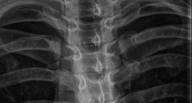 Scoliosis